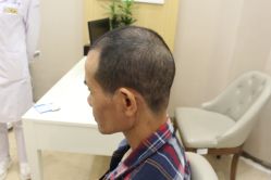 -大麦微针植发丨全国连锁