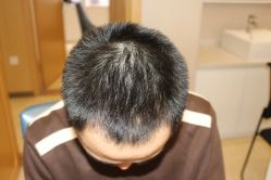 点击看大图 -大麦微针植发丨全国连锁