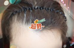 -大麦微针植发全国连锁