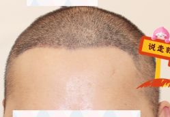 -大麦微针植发全国连锁