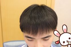 -大麦微针植发丨全国连锁