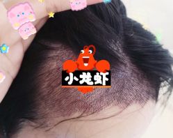 -大麦微针植发全国连锁