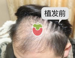 -大麦微针植发全国连锁