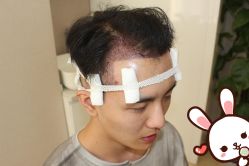 -大麦微针植发丨全国连锁