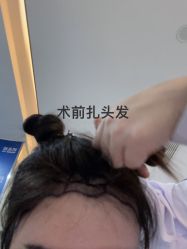 -碧莲盛·不剃发植发