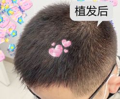 -大麦微针植发全国连锁