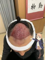 -大麦微针植发丨全国连锁