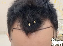 -大麦微针植发全国连锁