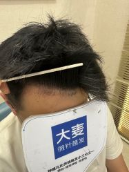 体验后-大麦微针植发丨全国连锁