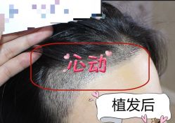 -大麦微针植发全国连锁