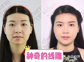 做完线雕为什么医生还推荐我打玻尿酸️
