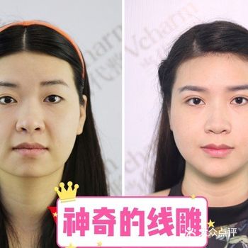 做完线雕为什么医生还推荐我打玻尿酸️
