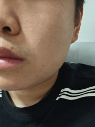-北京美痣堂古方祛痣斑疣瘊