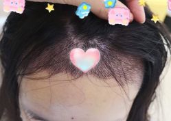 -大麦微针植发全国连锁