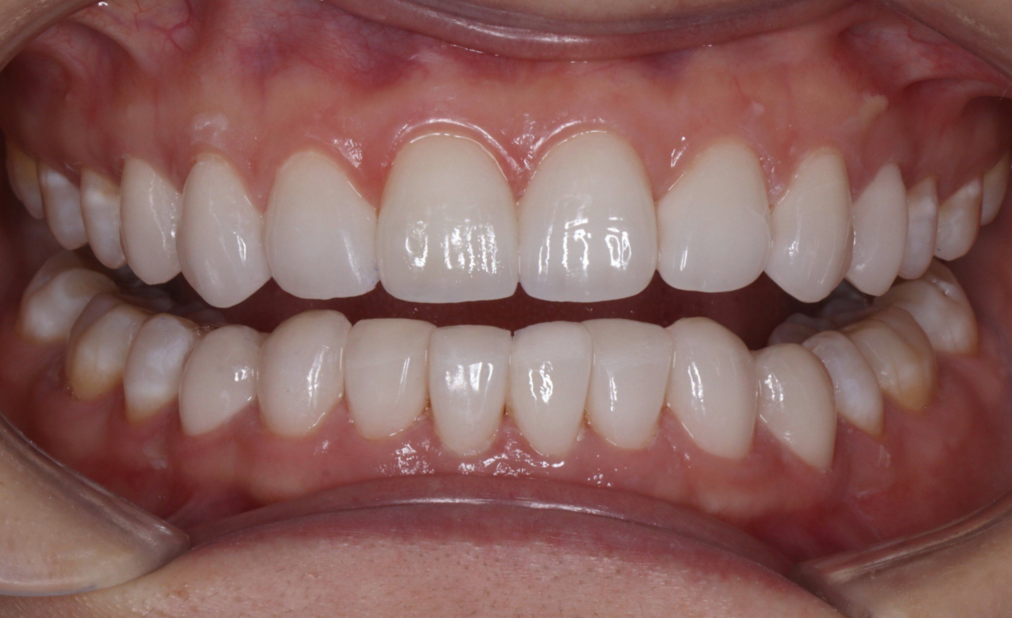 亮白牙齿自然闪耀