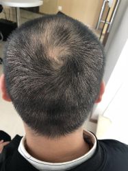 点击看大图 -大麦微针植发丨全国连锁