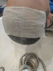 -碧莲盛·不剃发植发