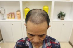 -大麦微针植发丨全国连锁