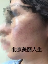 -美丽人生祛斑扁平疣汗管瘤中心