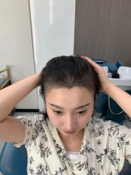 -大麦微针植发全国连锁