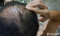 -大麦微针植发丨全国连锁