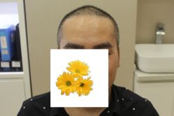 -大麦微针植发丨全国连锁