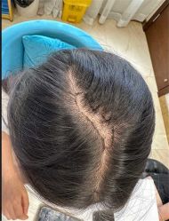 -碧莲盛·不剃发植发