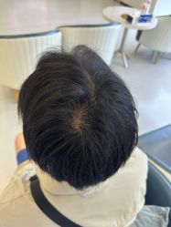 -大麦微针植发全国连锁