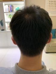 -大麦微针植发全国连锁