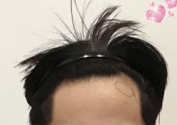 -大麦微针植发全国连锁