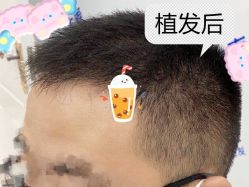 -大麦微针植发全国连锁