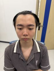 -大麦微针植发全国连锁