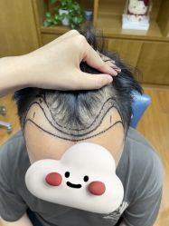 -大麦微针植发全国连锁