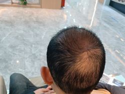 -碧莲盛·不剃发植发