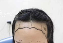 -大麦微针植发全国连锁
