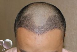 -大麦微针植发丨全国连锁