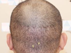 -大麦微针植发全国连锁