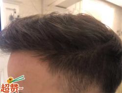 -大麦微针植发全国连锁