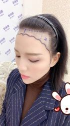 点击看大图 -大麦微针植发丨全国连锁