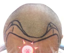 -大麦微针植发全国连锁