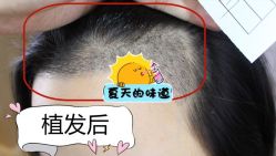 -大麦微针植发全国连锁