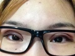 第一天~希望快点消肿-上海华安整形外科门诊部