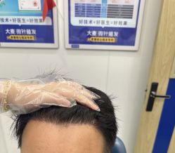 -大麦微针植发全国连锁