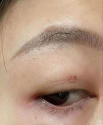 -北京美痣堂古方祛痣斑疣瘊