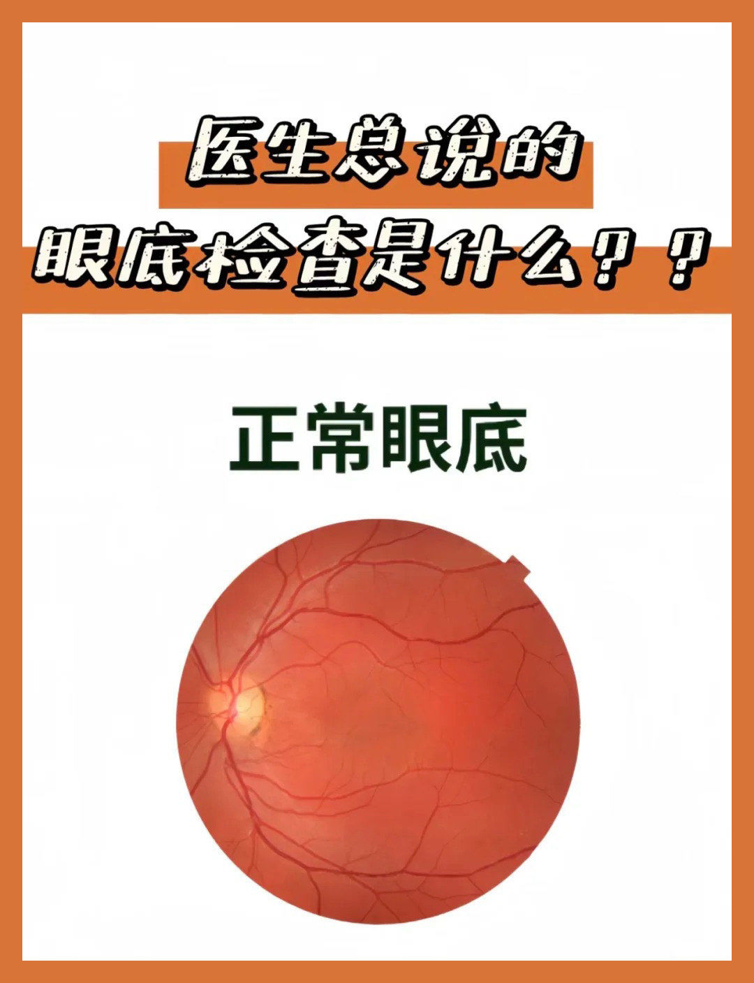 近视人群定期检查眼底的重要性?