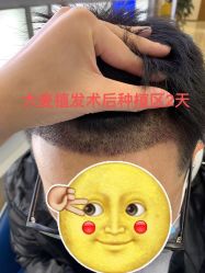 -大麦微针植发全国连锁