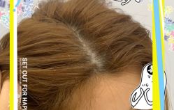 -大麦微针植发全国连锁