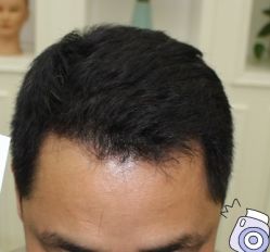 -大麦微针植发丨全国连锁