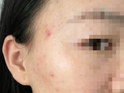 体验前-亿美医疗美容·半岛大超炮官方授权店