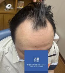 -大麦微针植发全国连锁